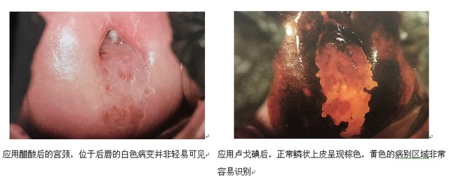 淺談電子陰道鏡作用以及碘反應(yīng)