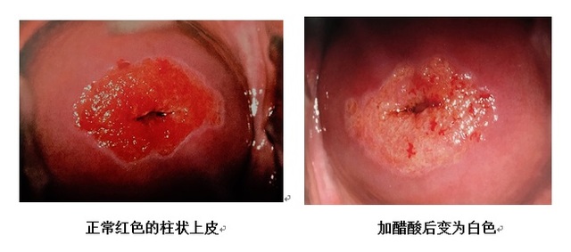 淺談電子陰道鏡作用以及碘反應(yīng)