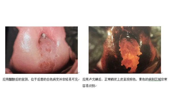 淺談電子陰道鏡作用以及碘反應(yīng)